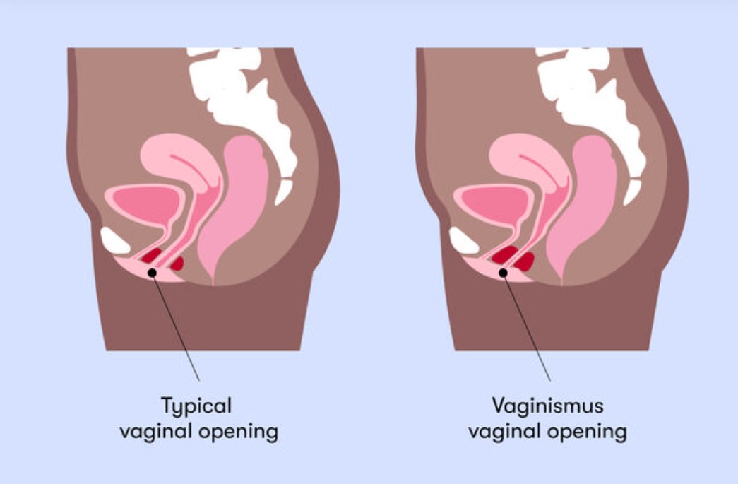 vaginizmus je sexuálna porucha
